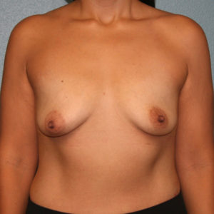 Gummy Bear Breast Implants