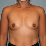 Gummy Bear Breast Implants