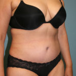 Tummy Tuck