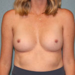 Breast Augmentation
