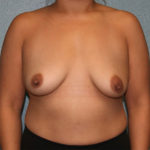Breast Augmentation