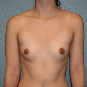 Breast Augmentation