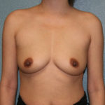 Breast Augmentation