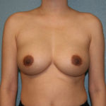 Breast Augmentation