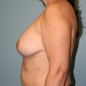 Breast Implant Removal