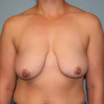 Breast Lift