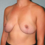 Breast Lift