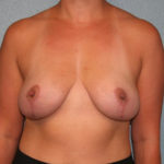Breast Lift