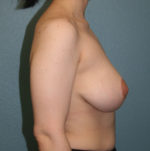 Breast Lift