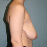 Breast Lift
