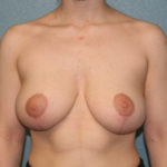 Breast Lift