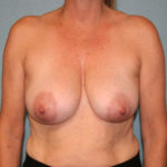 Breast Lift