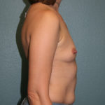 Gummy Bear Breast Implants