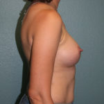 Gummy Bear Breast Implants