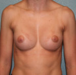 Gummy Bear Breast Implants