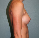 Gummy Bear Breast Implants