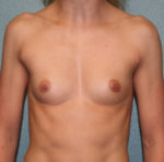 Gummy Bear Breast Implants