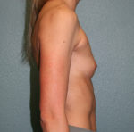 Gummy Bear Breast Implants