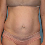 Tummy Tuck