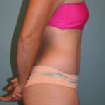 Tummy Tuck