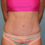 Tummy Tuck