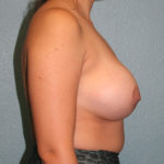 Breast Implant Revision