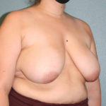 Breast Reduction