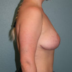 Breast Lift