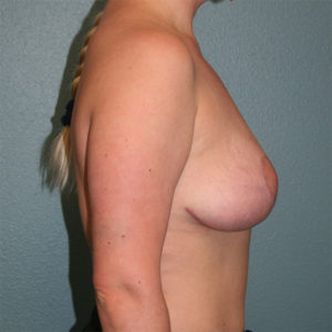 Breast Lift