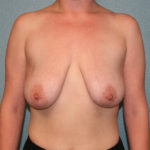 Breast Lift