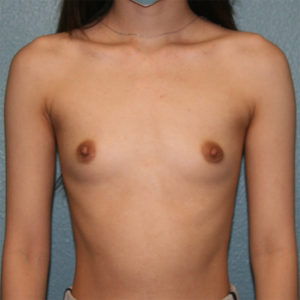 Gummy Bear Breast Implants