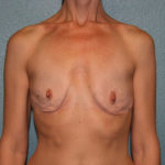 Breast Implant Revision