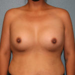 Breast Augmentation