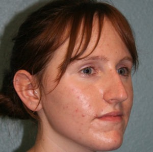 Nose Surgery (Rhinoplasty)