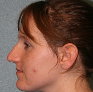 Nose Surgery (Rhinoplasty)