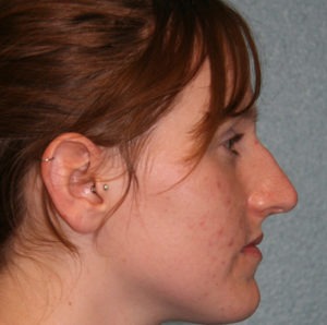 Nose Surgery (Rhinoplasty)