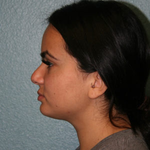 Neck Liposuction