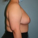 Breast Reduction