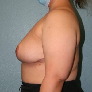 Breast Reduction