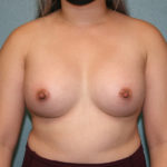 Breast Augmentation