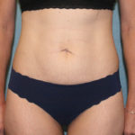 Tummy Tuck
