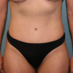 Tummy Tuck