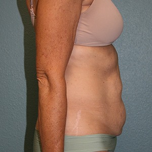 Tummy Tuck