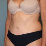 Tummy Tuck