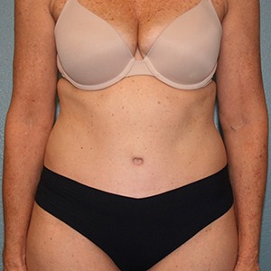 Tummy Tuck