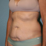 Tummy Tuck
