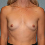 Breast Augmentation