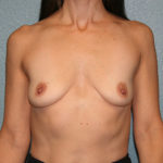 Breast Augmentation