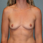 Breast Augmentation