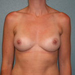 Breast Augmentation